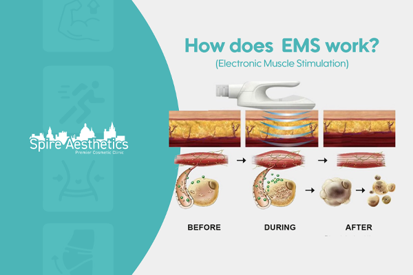 EMS treatment for post pregnancy weight loss treatment Baillieston