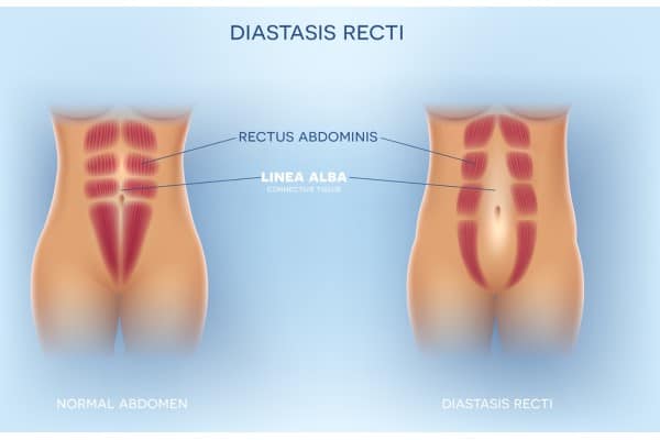 What Non-Surgical Options Are Available for Diastasis Recti Baillieston?