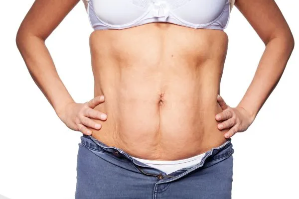 sagging skin on woman's stomach after weight loss injections Baillieston