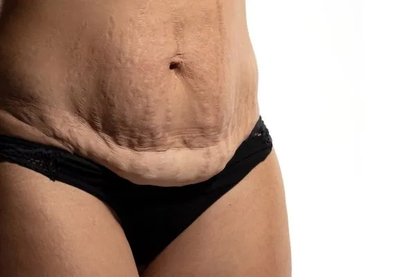 Image of womans stomach after weight loss injections Baillieston showing saggy skin