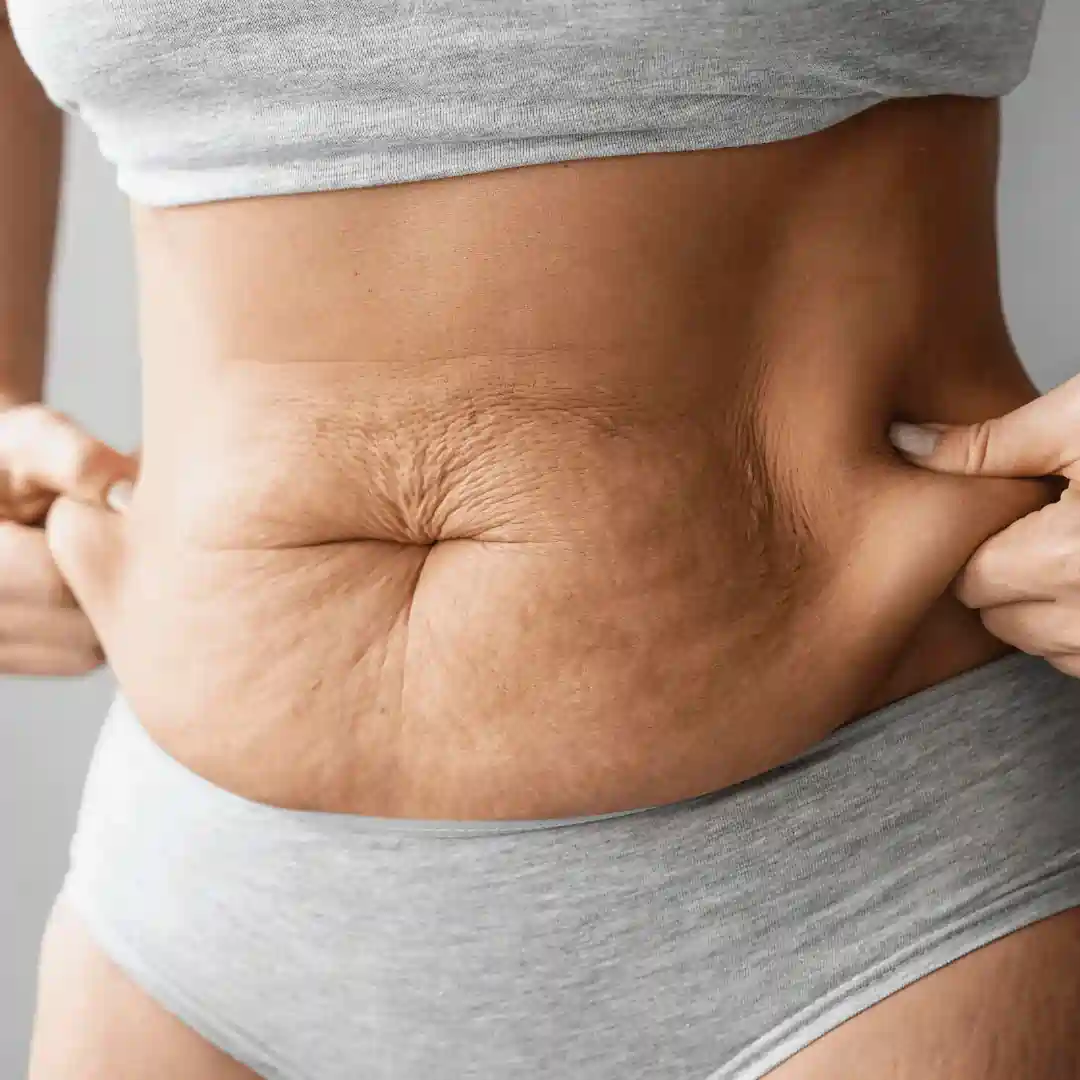 Is It Normal to Have Loose Skin After Pregnancy Baillieston?